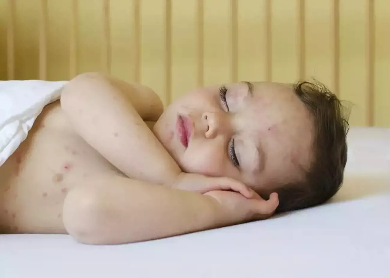Blog Image for article How to ease your child's eczema