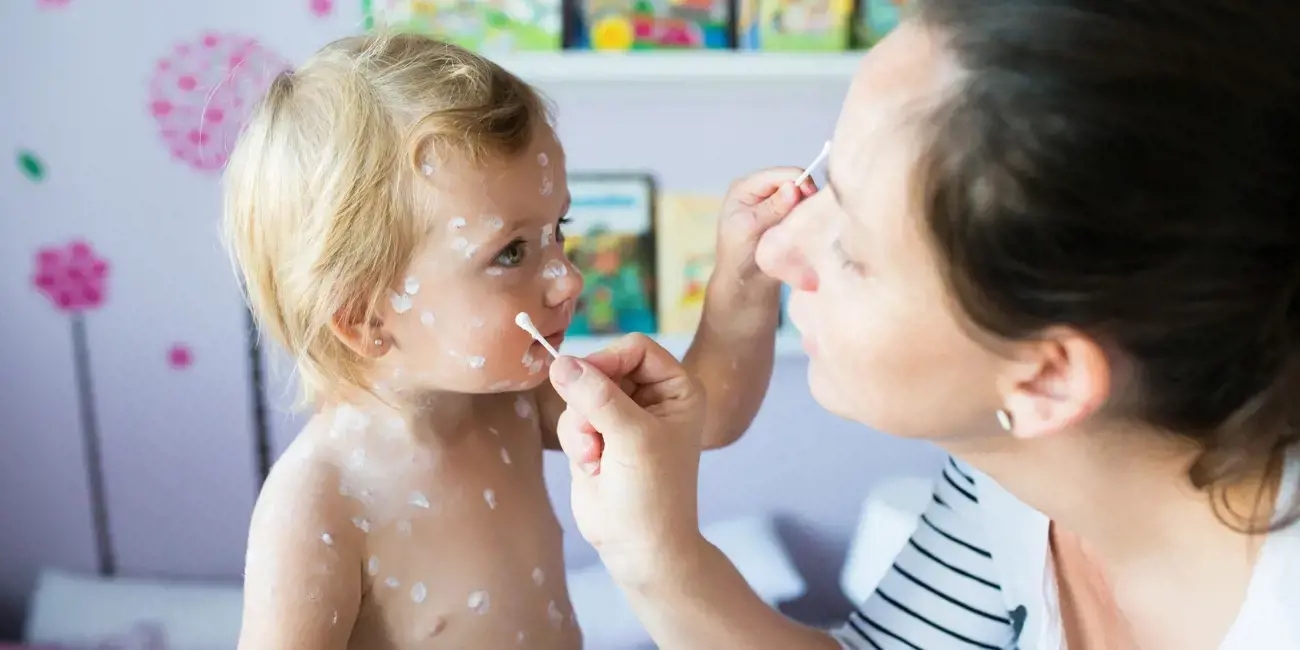Blog Image for article Chickenpox and childcare